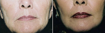 Chemical Peel before 1431803