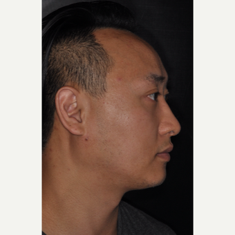 35-44 year old man treated with Nose Surgery 8 months post-op after 3500070