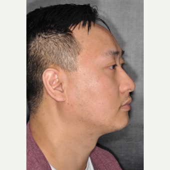 35-44 year old man treated with Nose Surgery 8 months post-op before 3500070