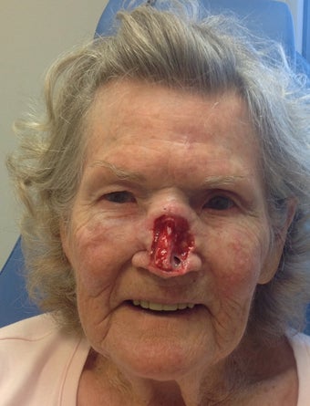 Total Nasal Reconstruction after MOHS before 1098240