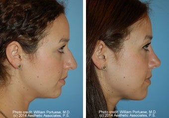 Rhinoplasty before 220747