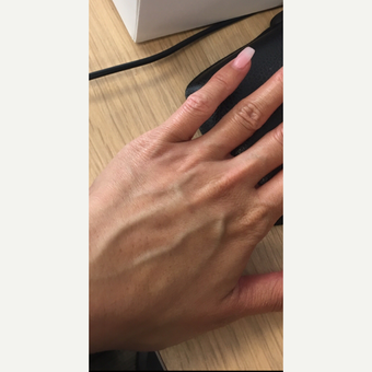 35-44 year old woman hands treated with Radiesse before 3305966