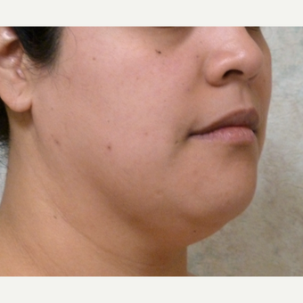 25-34 year old woman treated with Chin Liposuction before 3704060