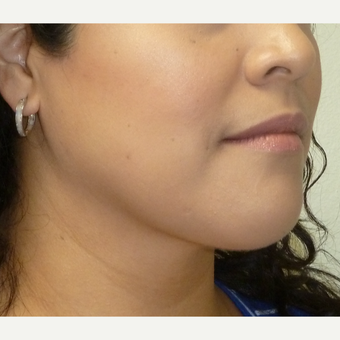 25-34 year old woman treated with Chin Liposuction after 3704060