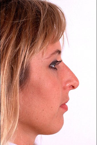 Rhinoplasty before 1023227
