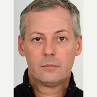 45-54 year old man treated with Injectable Filler (Teosyal) and Dysport before 2561021