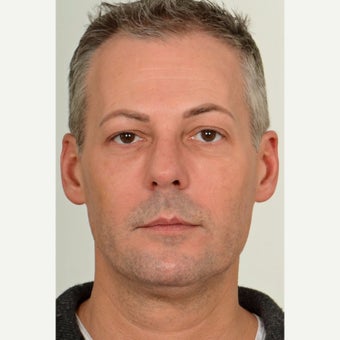 45-54 year old man treated with Injectable Filler (Teosyal) and Dysport after 2561021
