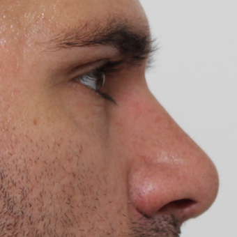 35-44 year old man treated with Rhinoplasty after 3544954