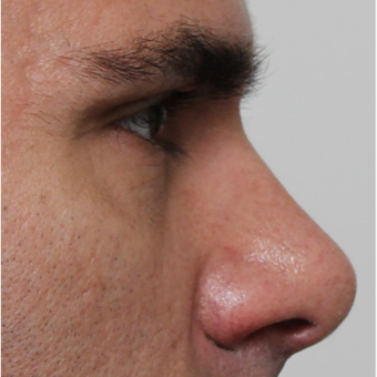35-44 year old man treated with Rhinoplasty before 3544954
