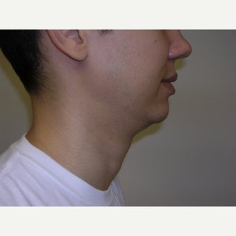 25-34 year old man treated with Kybella before 2258437