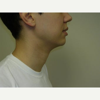 25-34 year old man treated with Kybella after 2258437