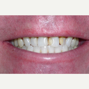 55-64 year old man treated with Dental Crown before 3448706