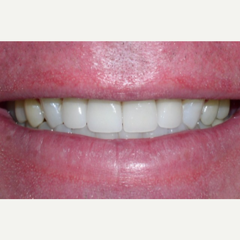55-64 year old man treated with Dental Crown after 3448706