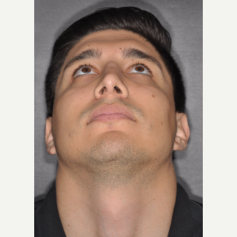 25-34 year old man treated with Nose Surgery 3 years post-op after 3814085