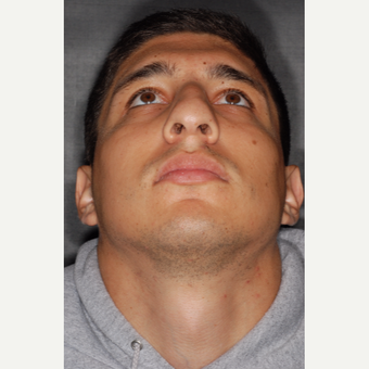 25-34 year old man treated with Nose Surgery 3 years post-op before 3814085
