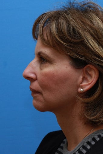 Necklift and Chin Enhancement after 251818