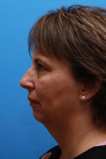 Necklift and Chin Enhancement before 251818