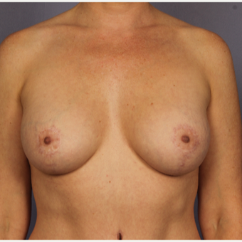 35-44 year old woman treated with Breast Lift with Implants after 3817107