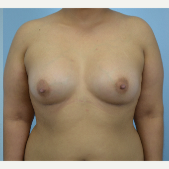 26 year old woman treated with Breast Augmentation- 500 cc high profile silicone gel implants after 3432265