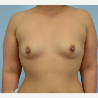 26 year old woman treated with Breast Augmentation- 500 cc high profile silicone gel implants before 3432265