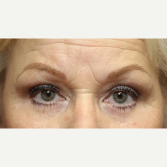 59 year old woman treated with an upper and lower lid blepharoplasty and lateral canthopexy after 2345443