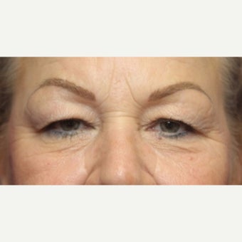 59 year old woman treated with an upper and lower lid blepharoplasty and lateral canthopexy before 2345443