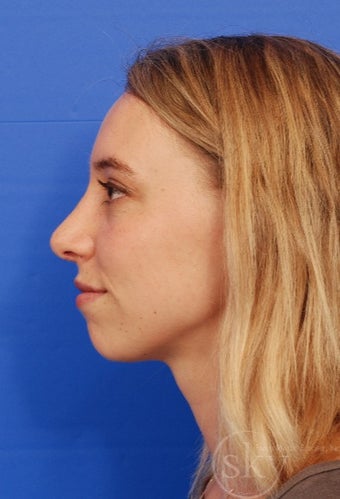 Rhinoplasty - Cosmetic after 3014796