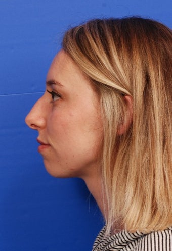 Rhinoplasty - Cosmetic before 3014796