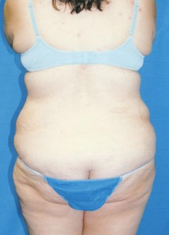 Circumferential Tuck 863788