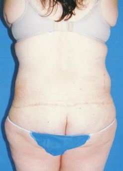Circumferential Tuck 863788