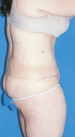 Circumferential Tuck after 863788