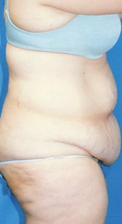 Circumferential Tuck before 863788