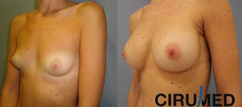 Breast augmentation 1333101