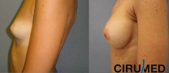 Breast augmentation 1333101
