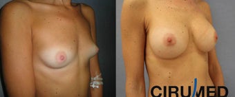 Breast augmentation after 1333101
