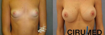 Breast augmentation before 1333101