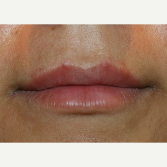 25-34 year old woman treated with Lip Augmentation after 3300184