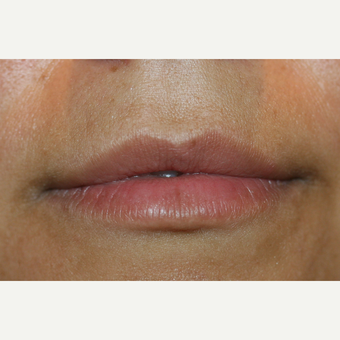25-34 year old woman treated with Lip Augmentation before 3300184