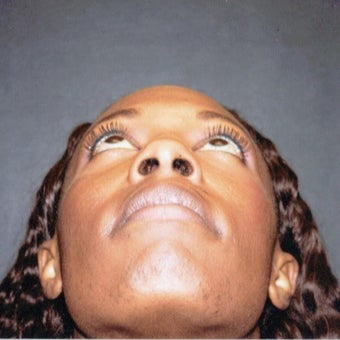 35-44 year old woman treated with African American Rhinoplasty 1539764