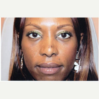 35-44 year old woman treated with African American Rhinoplasty after 1539764