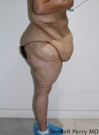 45-54 year old woman treated with Tummy Tuck before 3350929