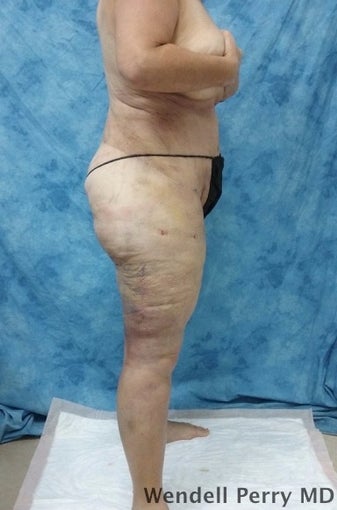 45-54 year old woman treated with Tummy Tuck after 3350929