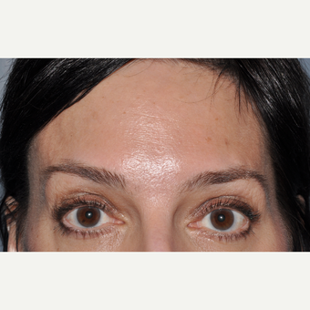 Botulinum toxin injection to forehead after 3374919
