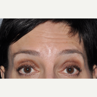 Botulinum toxin injection to forehead before 3374919