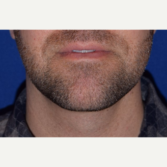 25-34 year old man treated with Chin Liposuction after 3638173