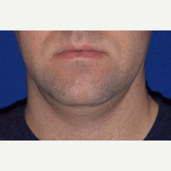 25-34 year old man treated with Chin Liposuction before 3638173