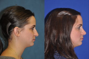 Rhinoplasty before 256042