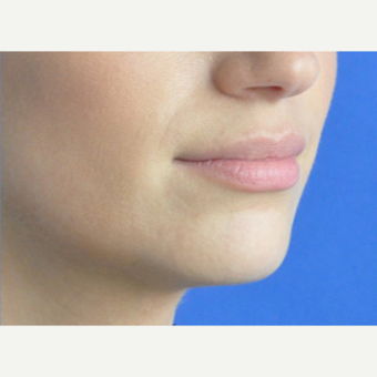 35-44 year old woman treated with Lip Augmentation after 3219110