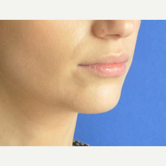 35-44 year old woman treated with Lip Augmentation before 3219110