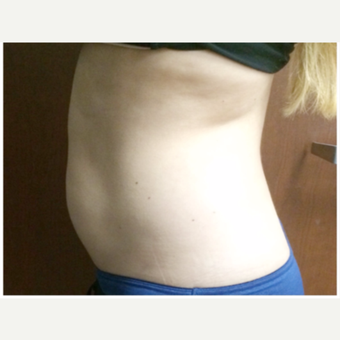 25-34 year old woman treated with SculpSure after 3265824